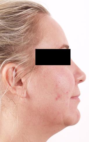Chin before