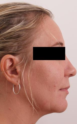 After Exilis